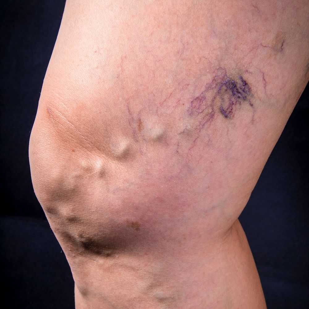 vein removal by prestige md clinic in thornhill and oshawa